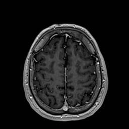 File:Cochlear incomplete partition type III associated with hypothalamic hamartoma (Radiopaedia 88756-105498 Axial T1 C+ 155).jpg