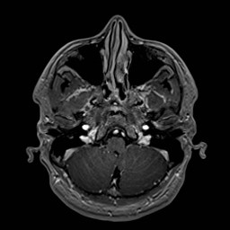 File:Cochlear incomplete partition type III associated with hypothalamic hamartoma (Radiopaedia 88756-105498 Axial T1 C+ 47).jpg