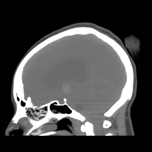 File:Colloid cyst (resulting in death) (Radiopaedia 33423-34499 B 30).png