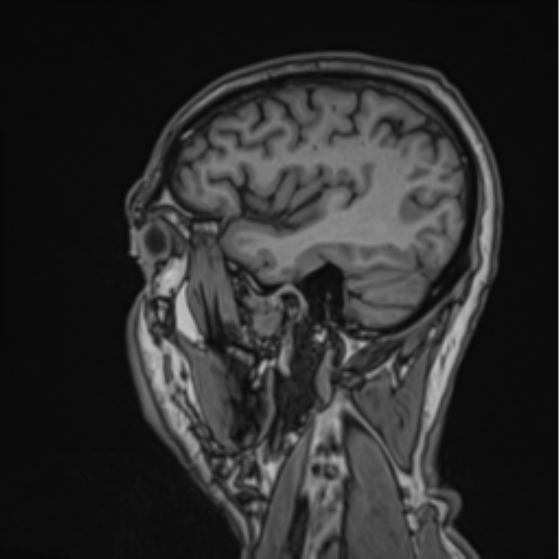 File:Colloid cyst of the third ventricle (Radiopaedia 86571-102662 Sagittal T1 18).png