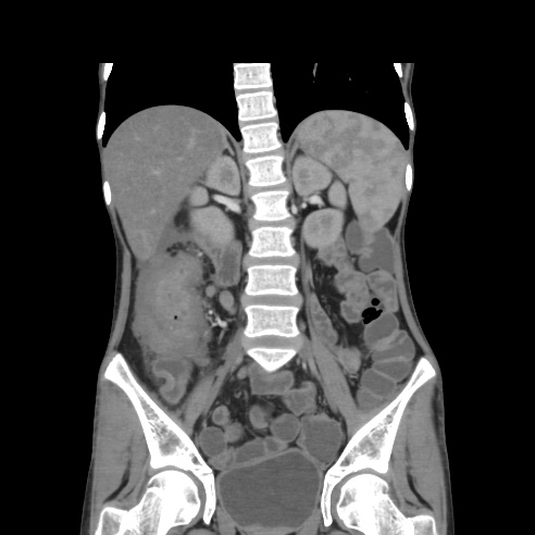 File:Colocolic fistula - Crohn disease (Radiopaedia 57063-63955 B 25).jpg