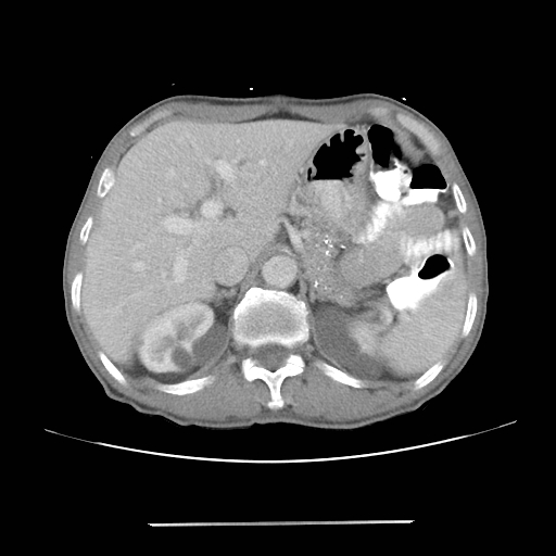 Colon cancer with calcified liver metastasis (Radiopaedia 74423-85307 A 20).jpg