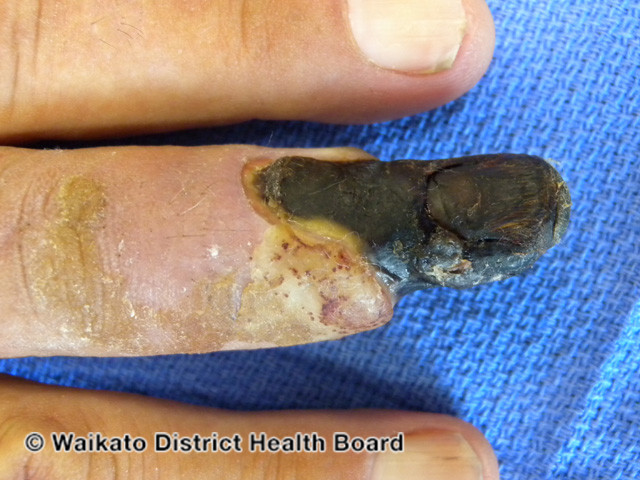File:Dry gangrene due to ischaemia (DermNet NZ vascular-w-gangrene-2).jpg