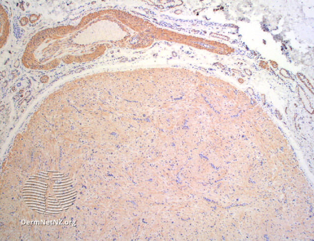 File:Figure 4 (DermNet NZ angioleiomyoma-figure4).jpg
