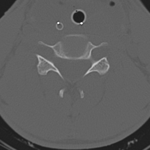 File:Multitrauma with diffuse axonal injury, temporal bone fractures and traumatic caroticocavernous fistula (Radiopaedia 37242-39035 Axial 171).png