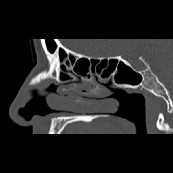 Nasal septal perforation (Radiopaedia 25030-25289 Sagittal bone window 21).jpg