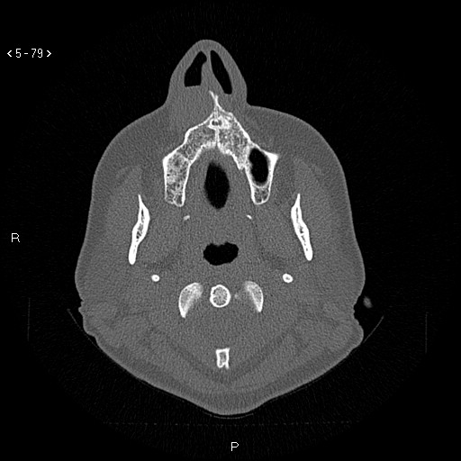 Nasolabial cyst (Radiopaedia 75125-86194 Axial bone window 40).jpg