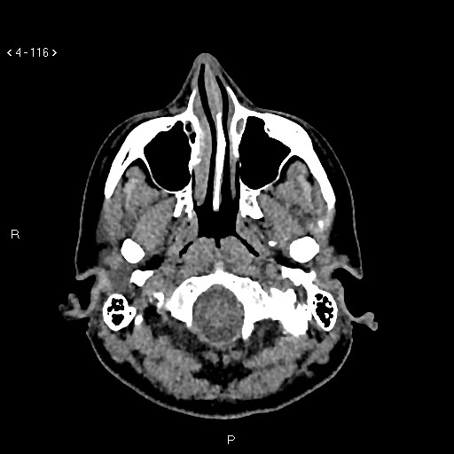 Nasolabial cyst (Radiopaedia 75125-86194 Axial non-contrast 78).jpg