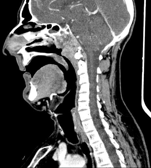 File:Nasopharyngeal carcinoma - infiltrating the clivus (Radiopaedia 62583-70875 C 28).jpg