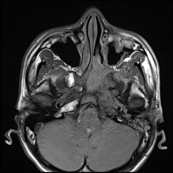 Nasopharyngeal carcinoma with skull base invasion (Radiopaedia 53415-59485 Axial T1 23).jpg