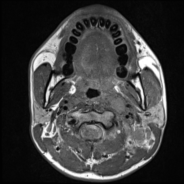 Nasopharyngeal carcinoma with skull base invasion (Radiopaedia 53415-59485 Axial T1 38).jpg