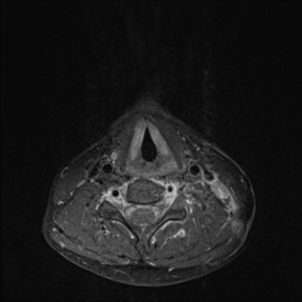 Nasopharyngeal carcinoma with skull base invasion (Radiopaedia 53415-59485 Axial T1 C+ fat sat 57).jpg