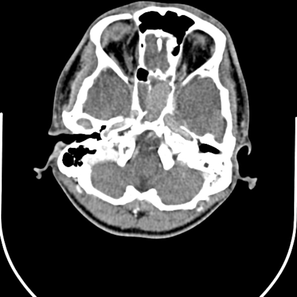 File:Nasopharyngeal carcinoma with skull base invasion (Radiopaedia 53415-59705 A 15).jpg