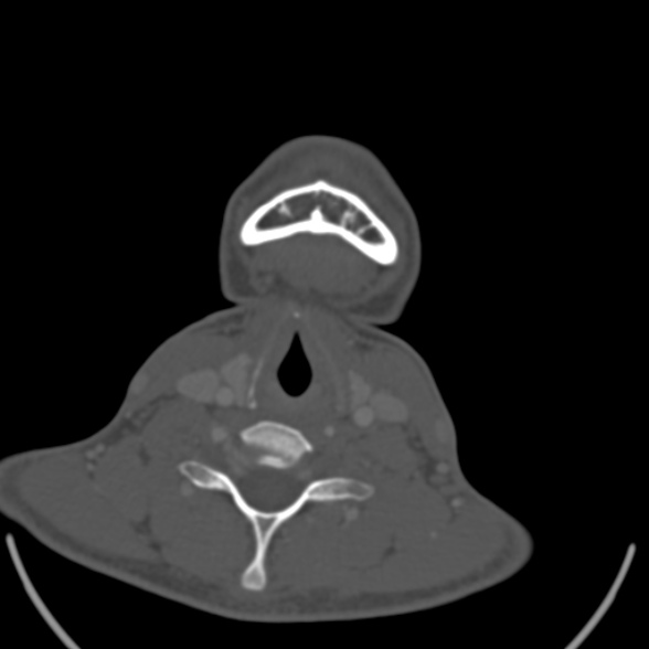 Nasopharyngeal carcinoma with skull base invasion (Radiopaedia 53415-59705 Axial bone window 153).jpg