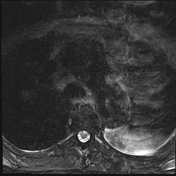 File:Nasopharyngeal carcinoma with skull base invasion (Radiopaedia 59258-66600 Axial T2 fat sat 37).jpg
