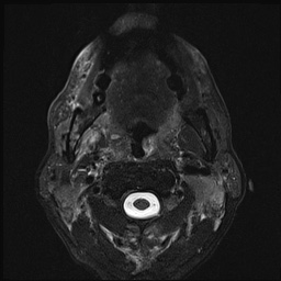File:Nasopharyngeal carcinoma with skull base invasion (Radiopaedia 59258-66600 D 32).jpg