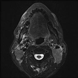 File:Nasopharyngeal carcinoma with skull base invasion (Radiopaedia 59258-66600 D 35).jpg