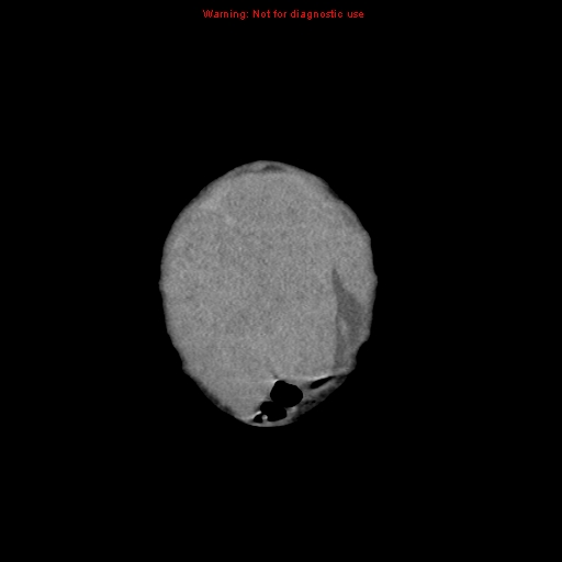 File:Neonatal neuroblastoma (Radiopaedia 9564-10223 B 12).jpg