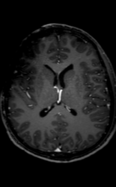 Neuro-Behçet disease (Radiopaedia 90112-107294 Axial T1 C+ 118).jpg