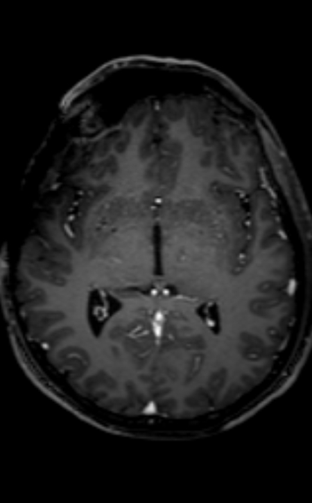 Neuro-Behçet disease (Radiopaedia 90112-107294 Axial T1 C+ 133).jpg