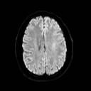 File:Neuro-Behcet's disease (Radiopaedia 21557-21506 Axial DWI 18).jpg