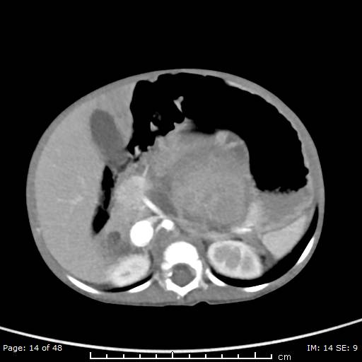 File:Neuroblastoma (Radiopaedia 41472-44355 A 14).jpg