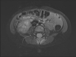 File:Neuroblastoma with bone metastases (Radiopaedia 67080-76414 Axial STIR 65).jpg