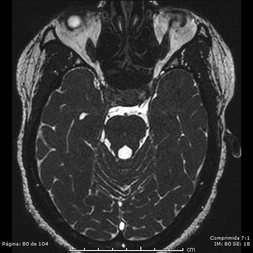 Neurocysticercosis (Radiopaedia 58636-65832 I 80).jpg