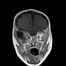 File:Neurofibromatosis type 1 (Radiopaedia 30089-30671 Coronal T1 C+ 7).jpg