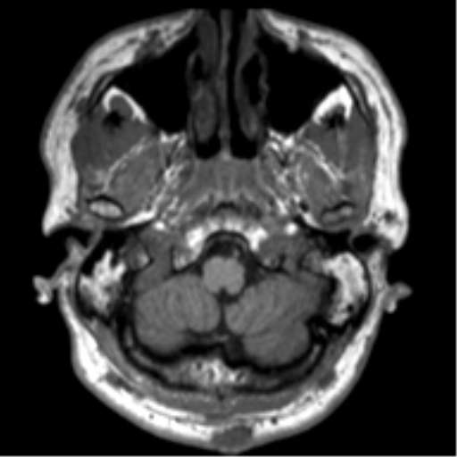 File:Neurofibromatosis type 2 (Radiopaedia 44936-48838 Axial T1 11).png