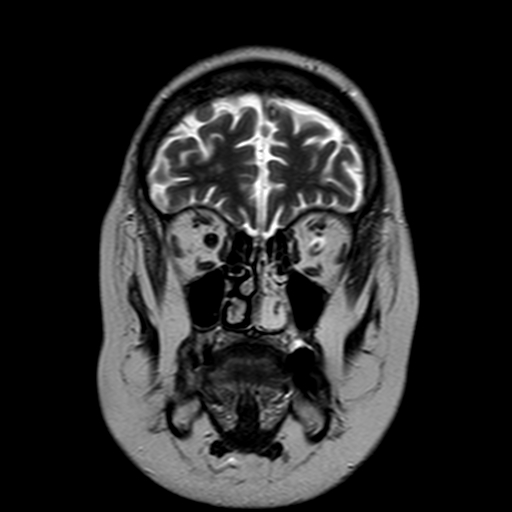 File:Neurofibromatosis type 2 (Radiopaedia 8713-9518 Coronal T2 3).jpg