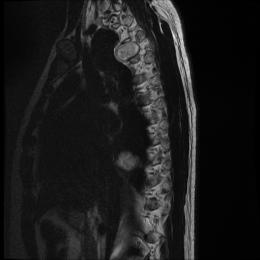 File:Neurofibromatosis type 2 (spinal manifestations) (Radiopaedia 53943-60070 C 13).png