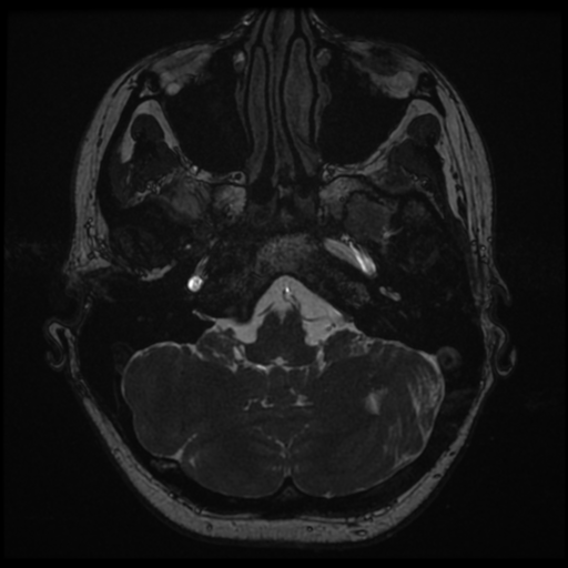 Neurofibromatosis type 2 - bilateral acoustic neuromata (Radiopaedia 40060-42566 Axial FIESTA 22).png