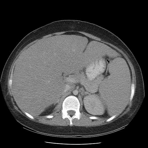 File:Non-Hodgkin lymphoma involving pelvis (Radiopaedia 21281-21197 A 24).jpg