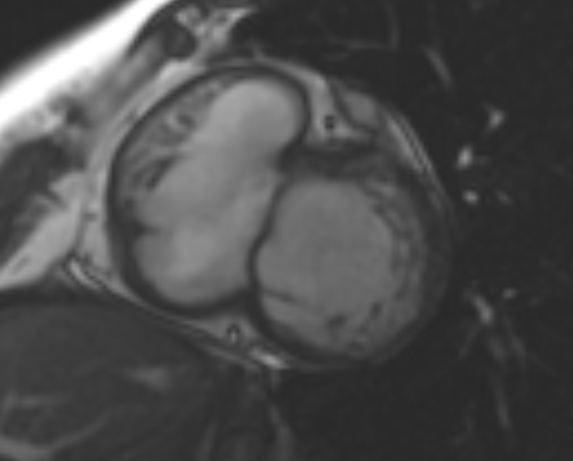 File:Non-compaction of the left ventricle (Radiopaedia 69436-79314 Short axis cine 176).jpg