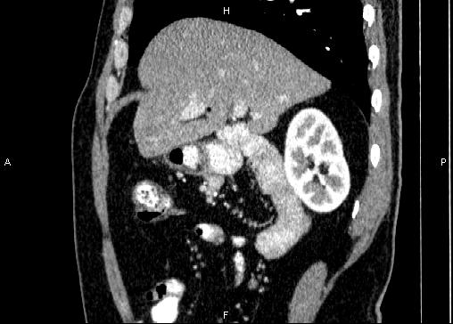 Non-syndromic pancreatic endocrine tumor (Radiopaedia 86958-103178 E 31).jpg