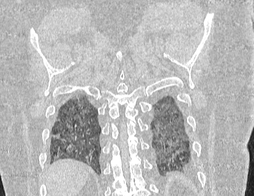 Non specific interstitial pneumonia (NSIP) (Radiopaedia 89725-106798 Coronal lung window 65).jpg