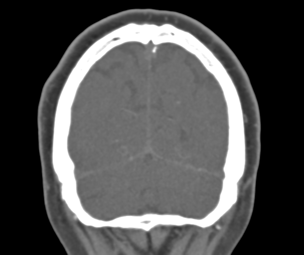 File:Normal CTA head (Radiopaedia 40801-43464 B 80).png