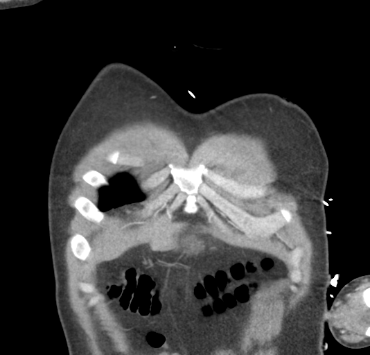 File:Normal CTA thorax (non ECG gated) (Radiopaedia 41750-44704 B 13).png