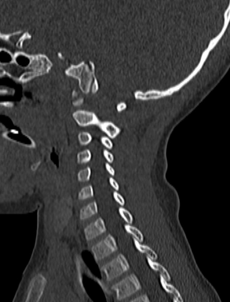 Normal CT cervical spine - pediatric (Radiopaedia 52549-58462 Sagittal bone window 66).jpg