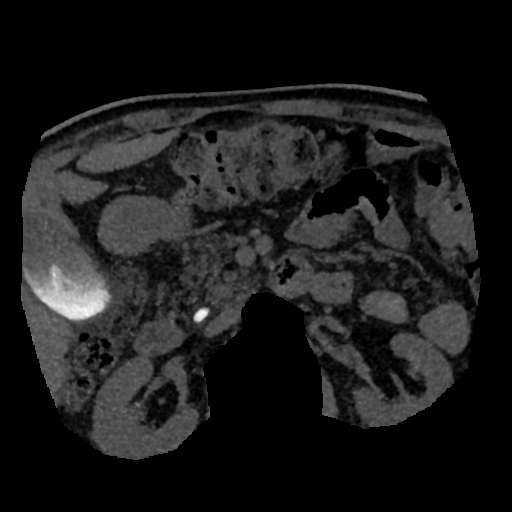 File:Normal CT intravenous cholangiogram (Radiopaedia 38199-40208 Axial IVC (MIP) 22).png