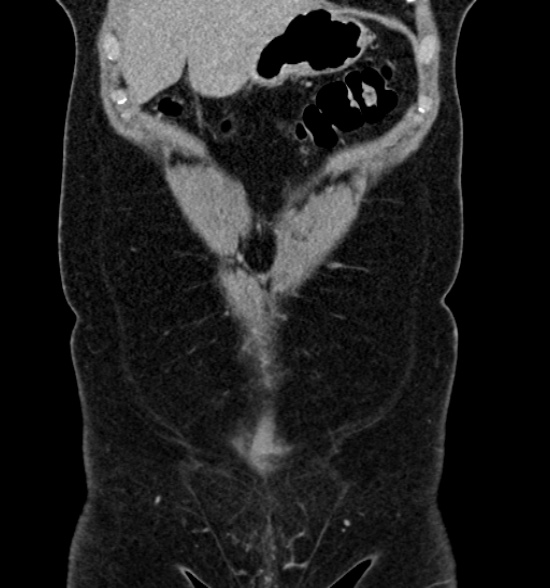 Normal CT intravenous urogram (Radiopaedia 39444-41759 A 182).jpg