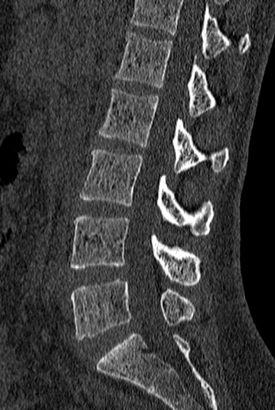 File:Normal CT lumbar spine (Radiopaedia 53981-60118 Sagittal bone window 46).jpg