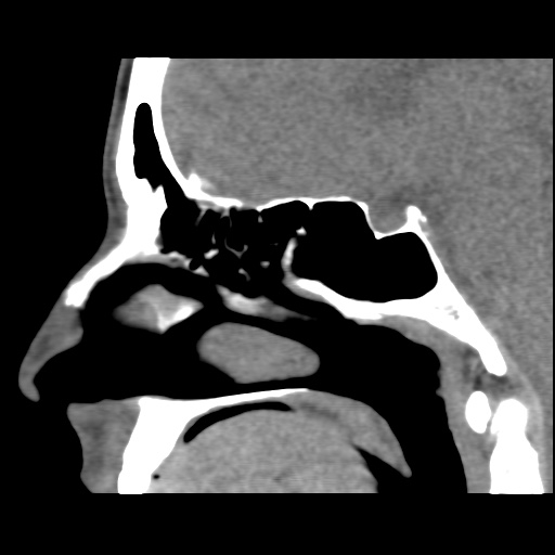 Normal CT paranasal sinuses (Radiopaedia 42286-45390 F 73).jpg