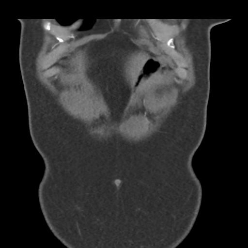 File:Normal CT renal artery angiogram (Radiopaedia 38727-40889 B 9).png