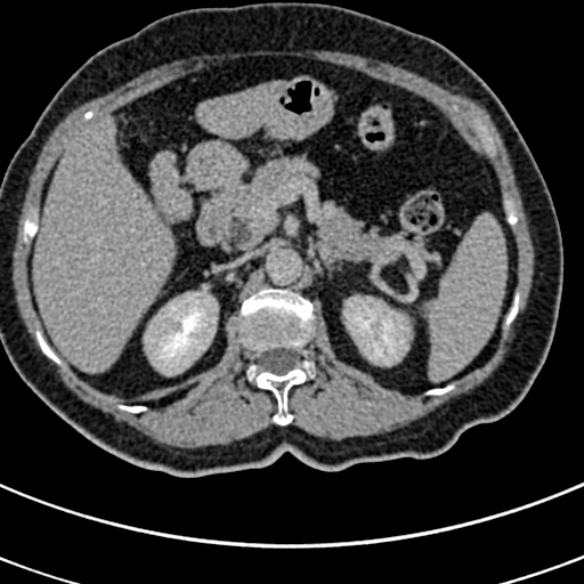 File:Normal CT split bolus study of the renal tract (Radiopaedia 48631-53634 Axial split bolus 39).jpg