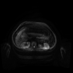 Normal MRI abdomen in pregnancy (Radiopaedia 88001-104541 Axial DWI 123).jpg