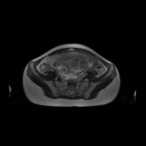 File:Normal MRI abdomen in pregnancy (Radiopaedia 88001-104541 Axial T2 51).jpg