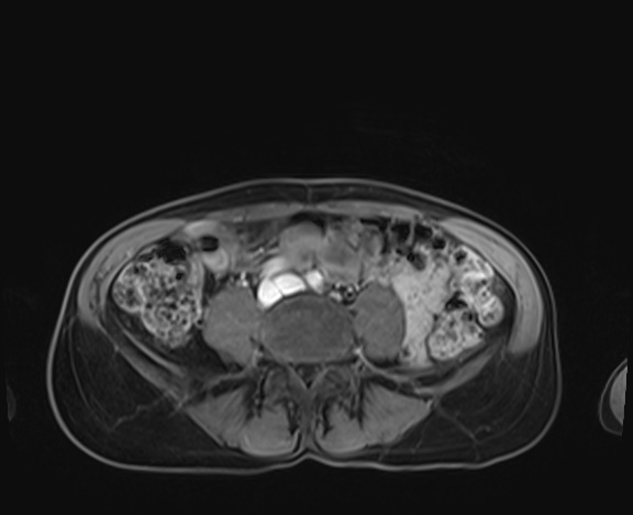 Normal adrenal glands MRI (Radiopaedia 82017-96004 K 71).jpg
