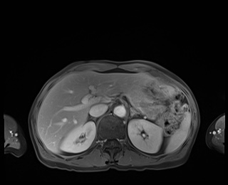 Normal adrenal glands MRI (Radiopaedia 82017-96004 M 27).jpg